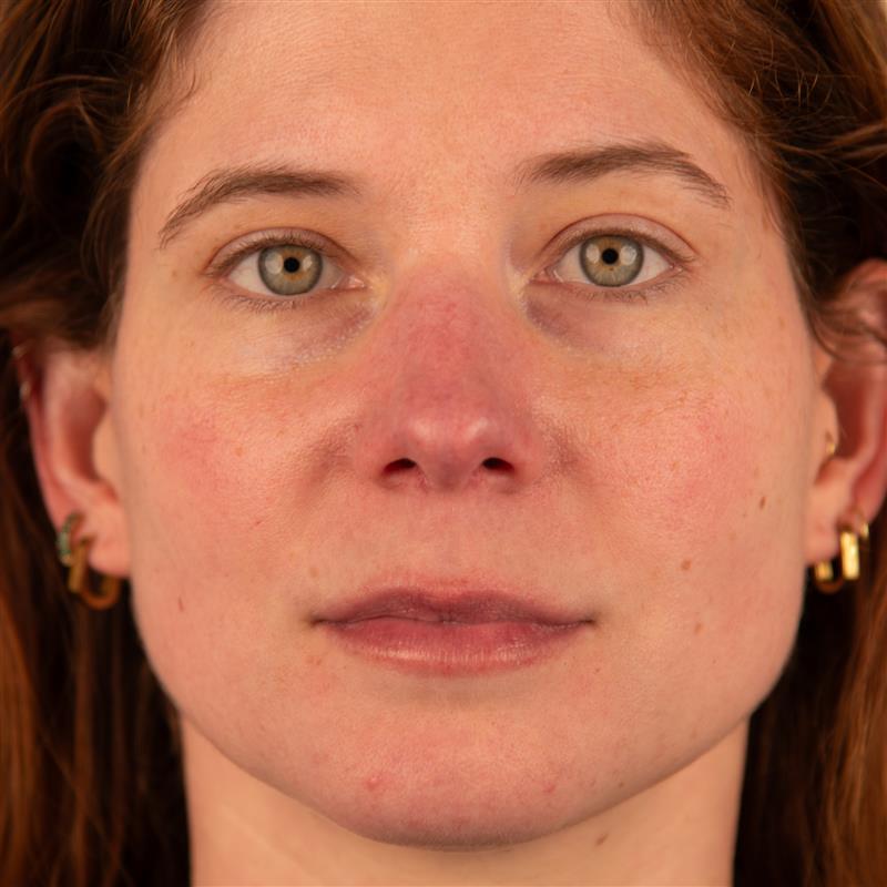 Polyglutamic+ Booster serum before and after 2 weeks Trilogy AU skin hydrating results